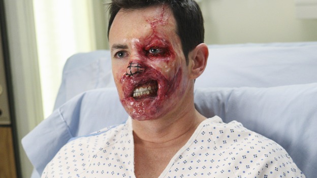GREY'S ANATOMY - "Stand By Me" - Dave aka "Blowhole" before his face transplant surgery, on "Grey's Anatomy," THURSDAY, MARCH 19 (9:00-10:02 p.m., ET) on the ABC Television Network. (ABC/CRAIG SJODIN) LARRY SULLIVAN